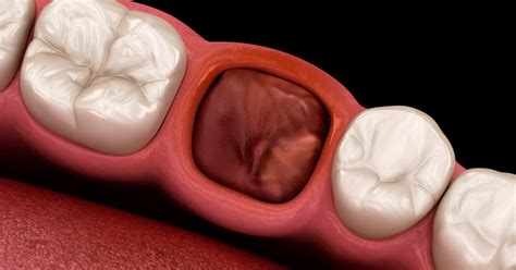 Image result for Tooth Extraction Look Like