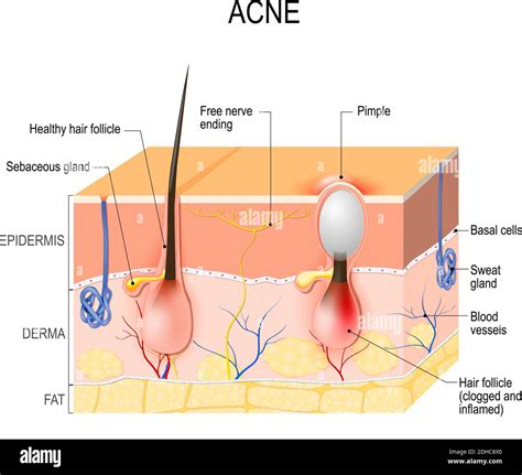 What Does Pimple Pus Look Like Under A Microscope at Dakota Bunce blog