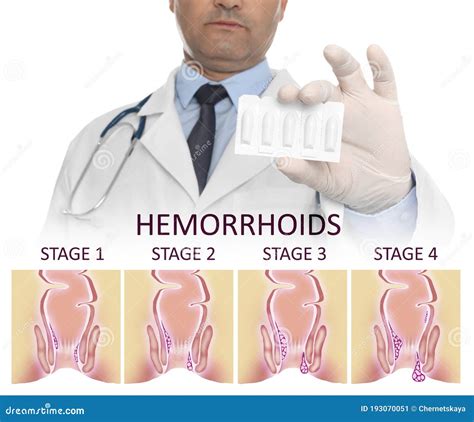 Doctors For Hemorrhoid
