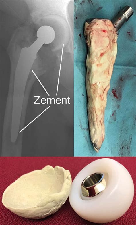 Ein neuer beweglicher Antibiotika-Spacer für die infizierte Hüftprothe ...