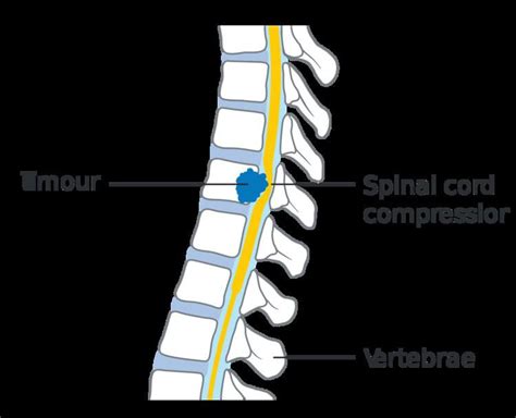 Spinal Cord Compression 的图像结果