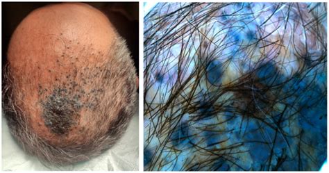 Diagnostic Imaging of Agminated Blue Lesions and Blue Lesions with ...