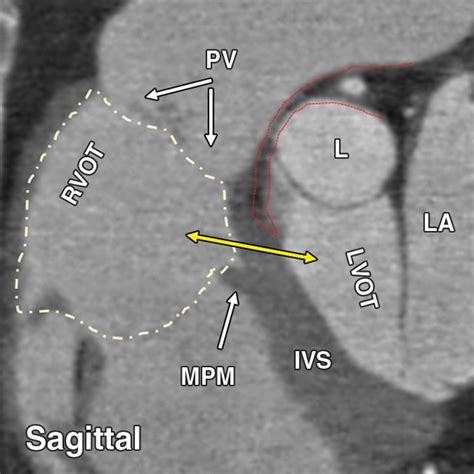 Right Ventricular Outflow Tract Imaging With CT and MRI: Part 1 ...