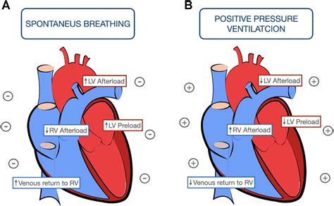 Complex Heart–Lung Ventilator Emergencies in the CICU - Cardiology Clinics