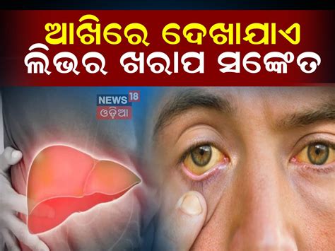 Liver Cirrhosis: ଆଖିରେ ଦେଖାଯାଏ ଲିଭର ଖରାପ ହେବା ସଙ୍କେତ! କଲେ ଅଣଦେଖା ...