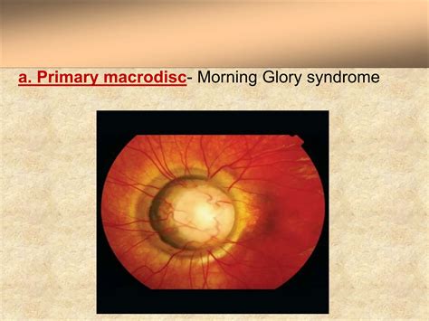 Morning Glory Syndrome