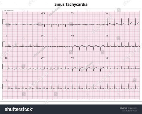 Sinus Tachycardia Curable