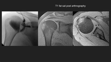 Mr Arthrogram Shoulder 的图像结果