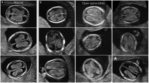 Choroid Plexus Ultrasound