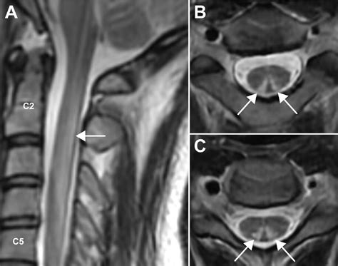 “Inverted V” sign in subacute combined degeneration of the spinal cord ...