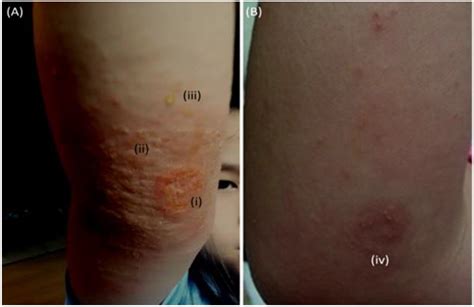 Staphylococcus Infection: Relapsing Atopic Dermatitis and Microbial Restoration