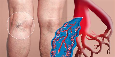 Deep Vein Thrombosis (DVT) | Apex Vascular
