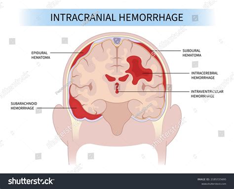 Intracerebral Hemorrhage Vs Subarachnoid Hemorrhage