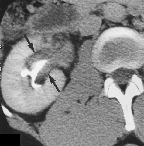 Diagnosis of Renal Pelvis Subepithelial Hemorrhage Using Unenhanced Helical CT | AJR
