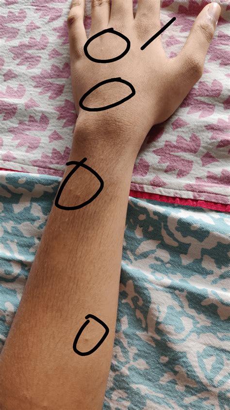 Guys what are these red marks on my arm? : r/medical