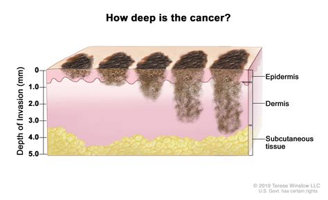 Melanoma Skin Cancer Stages