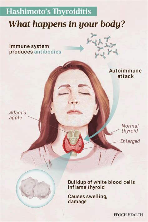 Tiroiditis de Hashimoto: síntomas, causas, y tratamientos – eju.tv