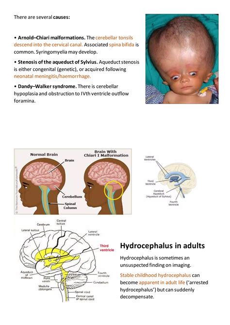 hydrocephalus.docx