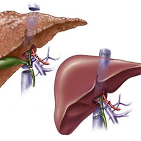 Best Liver Transplant Surgeon in India | Dr. Punit Singla