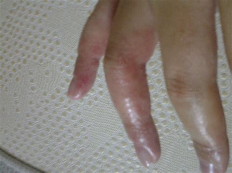 手指的皮肤起泡，像被烫伤一样。_百度知道
