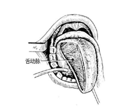 半舌切除术过程图解-手术图解,_医学图库