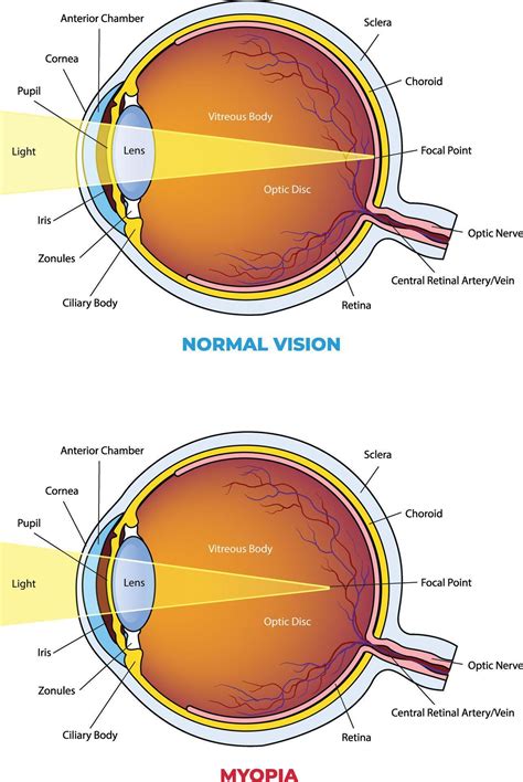 illustration of Myopia vs normal eye diagram 54068166 Vector Art at ...