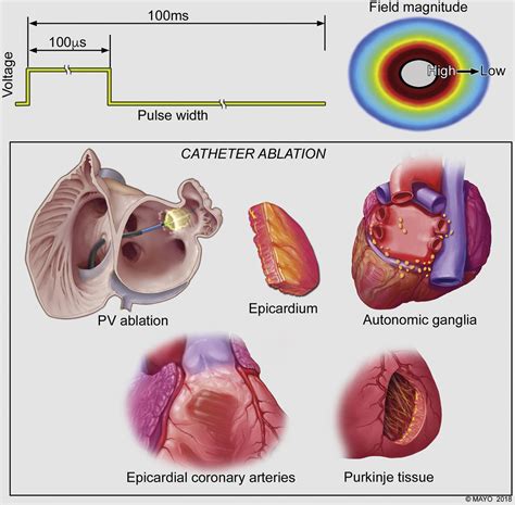 Pulsed electric fields for cardiac ablation and beyond: A state-of-the ...
