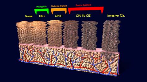 CIN Cervical cancer intraepithelial neoplasia - Buy Royalty Free 3D model by Deepankar.Parmar ...
