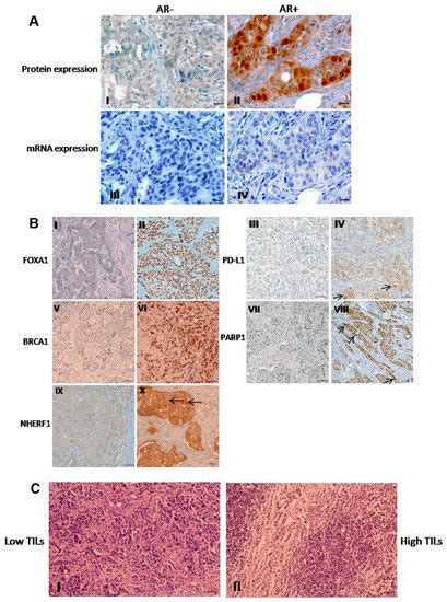 Should Tumor Infiltrating Lymphocytes, Androgen Receptor, and FOXA1 ...