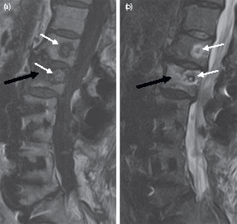 Complications of Basivertebral Nerve Ablation | Anesthesia Key