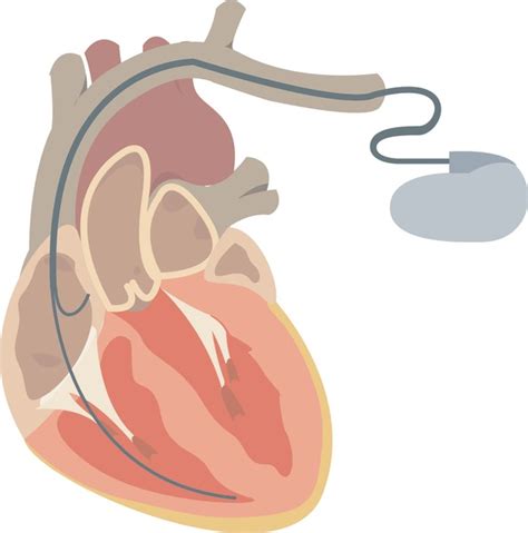 Pacemaker Procedure 的图像结果