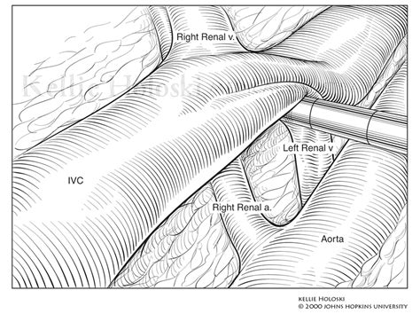 Image result for Hal Nephrectomy