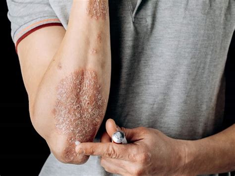 Side Effects Of Topical Steroids On The Skin | TheHealthSite.com