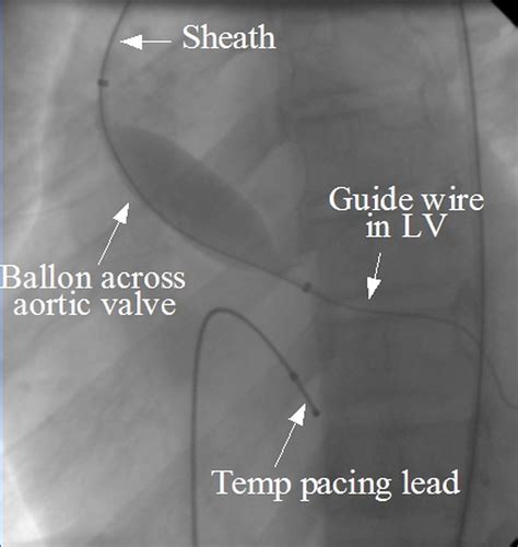 Balloon aortic valvuloplasty - All About Heart And Blood Vessels