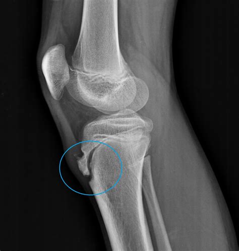 Morbus Osgood Schlatter Mrt , Morbus Osgood Schlatter, Kinderorthopädie ...