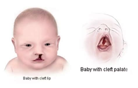 Occurrence of oral clefts linked to ABO, Rh blood groups, lip ...