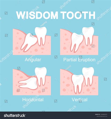 Erupted Wisdom Tooth