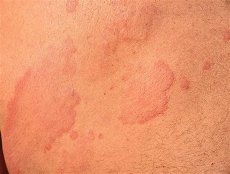 Pictures of Hives (Urticaria) to Help Identify a Skin Rash