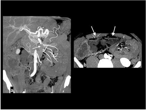 Diagnostic Role of Multi-Detector Computed Tomography in Acute Mesenteric Ischemia