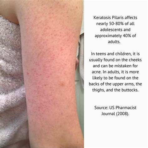 Vitamin B Keratosis Pilaris at Jerome Weeks blog