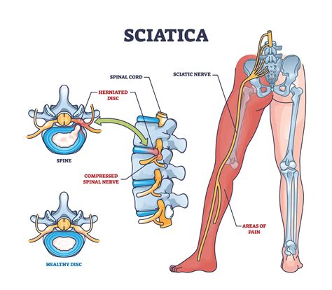 Sciatica (Lumbar Radiculopathy) - Pain Institute of Southern Arizona