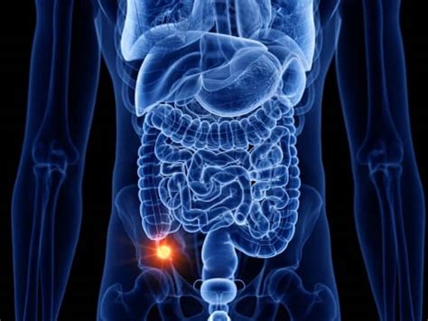 Image result for Appendix Cancer Symptoms