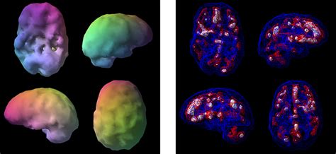 Image result for SPECT Scan Brain Prefrontal Cortex