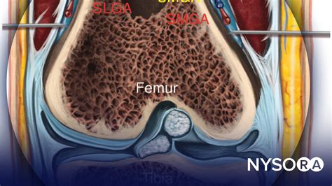 Genicular Nerve Blocks - NYSORA | NYSORA