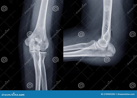X-ray of Elbow Join Showing Fracture of Ulna Bone Stock Photo - Image ...