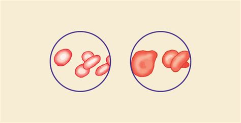 Difference Between Iron deficiency anemia and megaloblastic anemia – Knya