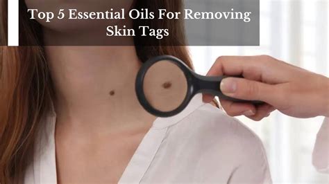 Top 5 Essential Oils For Removing Skin Tags