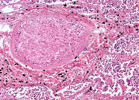 Infected Abscess Lanced 的图像结果