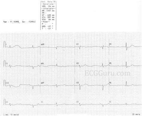 Junctional Escape Rhythm Treatment Did You Know Why There’re Called