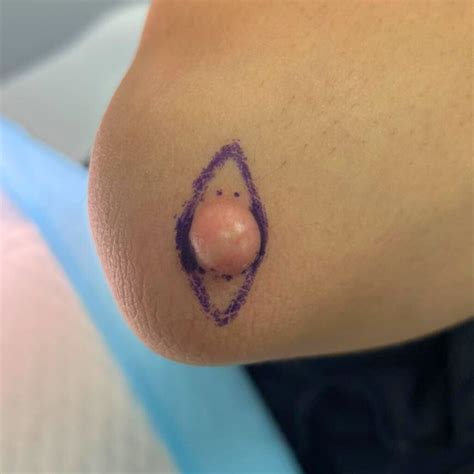 Image result for Sebaceous Cyst Removal Procedure